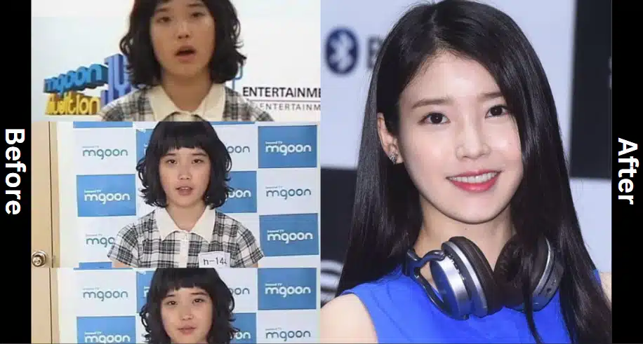 IU before and after comparison